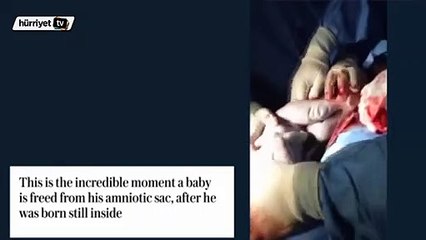 Yenidoğan bu bebek doktorları hayretler içerisinde bıraktı!