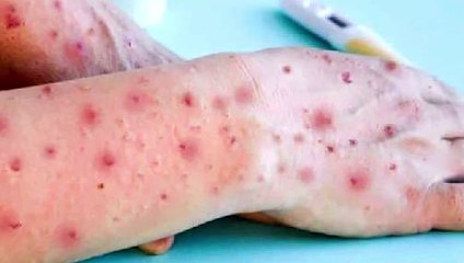 Varíola dos macacos: primeira morte é registrada em São Paulo