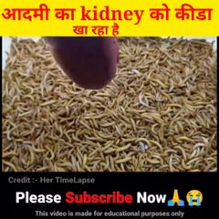 इंसान को किडनी को खा रहा है कीडा देखिये कैसे खा रहा है facts video a