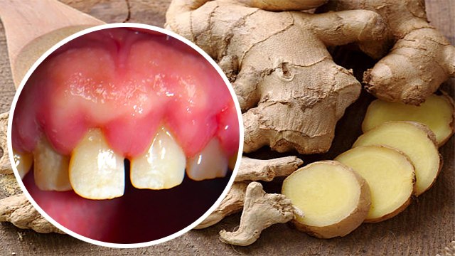 मसूड़ों में सूजन दूर करेगी ये एक चीज । Masudo Me Sujan Dur Karege Yh Yk Chiz । Boldsky *Health