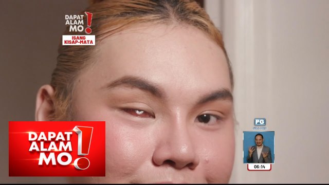 Isang mata ng 22-anyos na content creator, bakit kinailangang tanggalin? | Dapat Alam Mo!