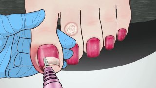 ASMR｜Ingrown Toenail and Corn removal treatment animation
