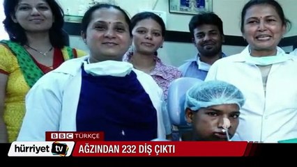 Hindistan'da genç adamın ağzından 232 diş çıktı