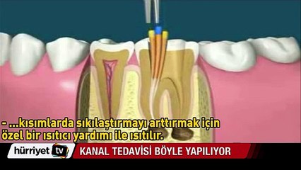 İnsanları korkudan titreten kanal tedavisi nasıl yapılıyor