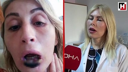 Kaybettiği alt dudağı eskisi gibi olmayacak