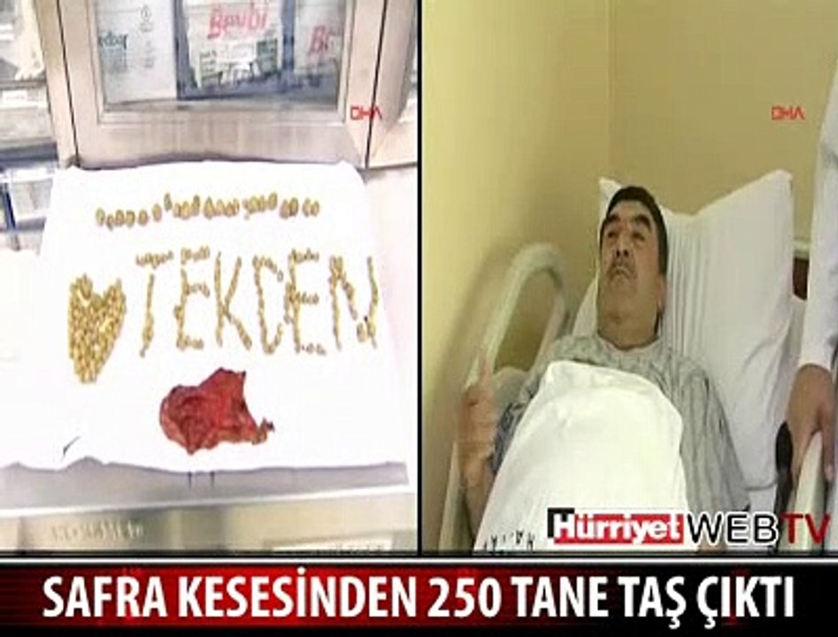 SAFRA KESESİNDEN 250 TAŞ ÇIKTI