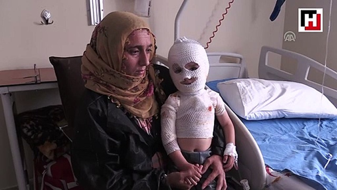 Üzerine kaynar su dökülen minik Yunus Emre iyileşeceği günü bekliyor