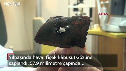 Havai fişek gözüne saplandı