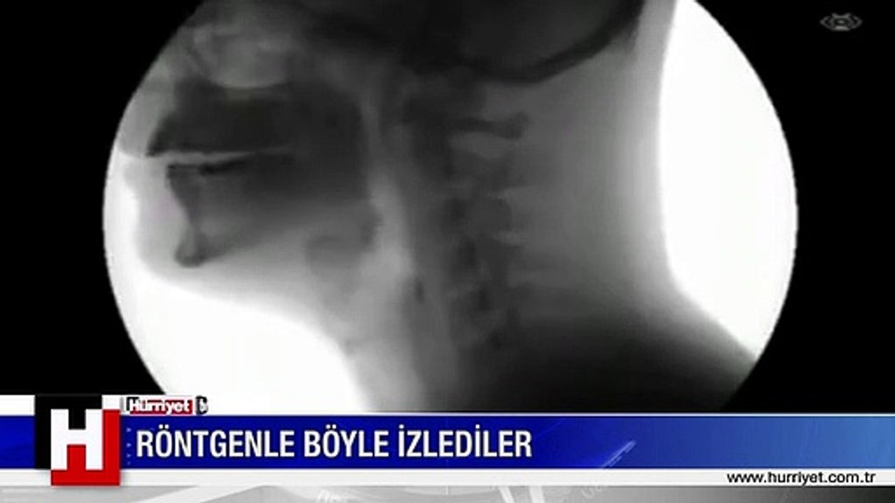 RÖNTGEN MAKİNESİ İLE ÇEKTİLER