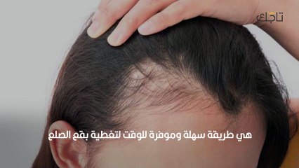 تساقط الشعر من جانب واحد_ الأسباب والعلاج