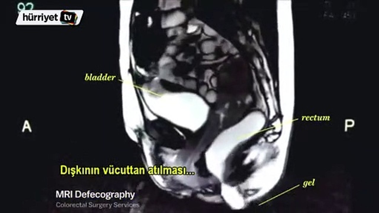MRI taraması