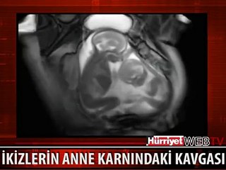 İKİZLERİN ANNE KARNINDA KAVGASI