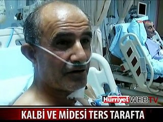 KALBİ VE MİDESİ TERS TARAFTA