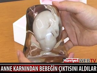 ANNE KARNINDAN BEBEĞİN ÇIKTISINI ALDILAR