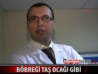 BÖBREĞİNDEN 150 TANE TAŞ ÇIKTI