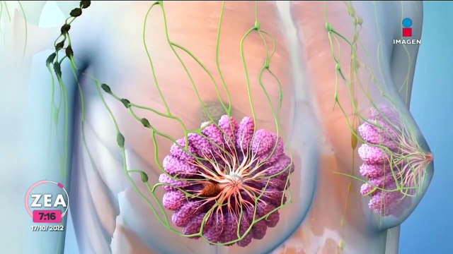 Cáncer de mama: factores de riesgo