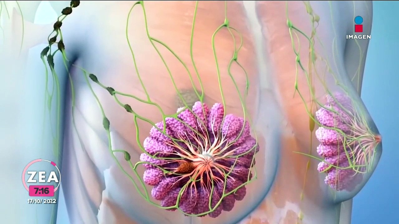 Cáncer de mama: factores de riesgo