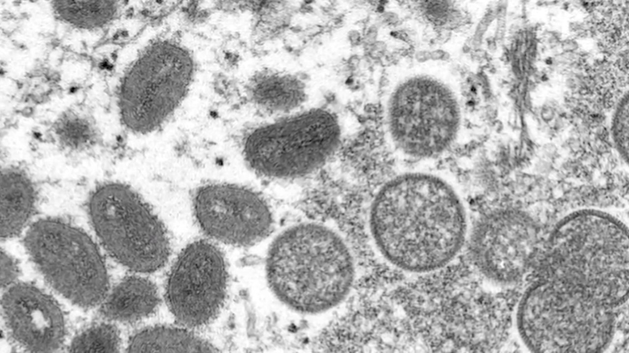 Monkeypox Reaches Taiwan