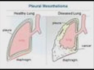 Mesothelioma Signs and symptoms
