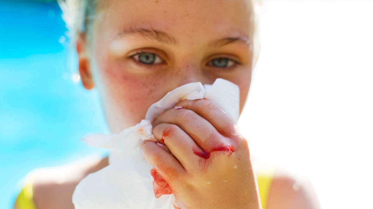 Nasenbluten bei Kindern: Was Eltern unbedingt darüber wissen sollten!