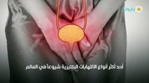 التهاب المسالك البولية