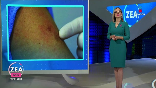 Viruela del mono: estos son los estados que registran más casos positivos