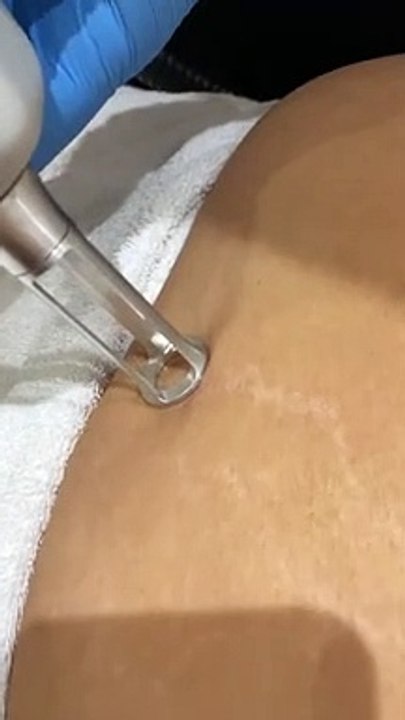 Fractional Laser Skin Resurfacing