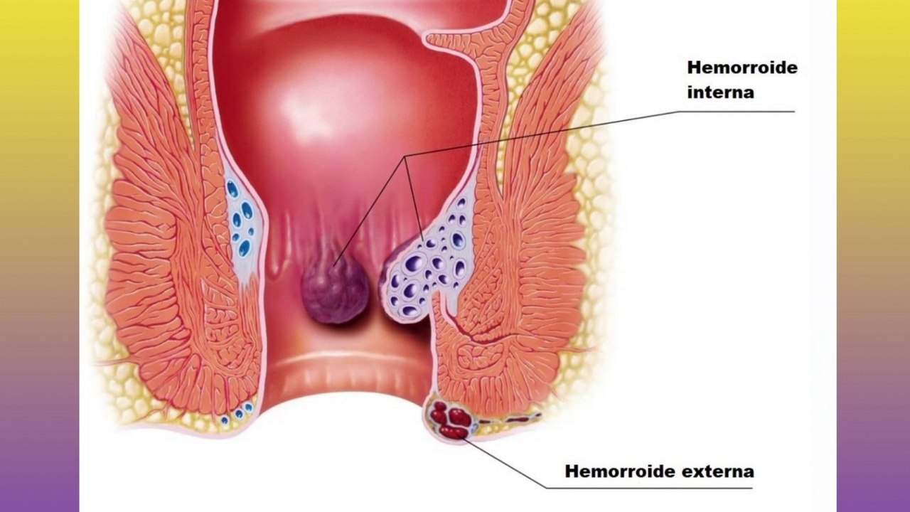bd-que-hacer-si-hay-sintomas-de-hemorroides-261022