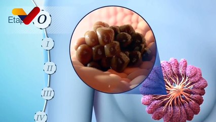 Cáncer de mama: enfermedad que también afecta a los hombres