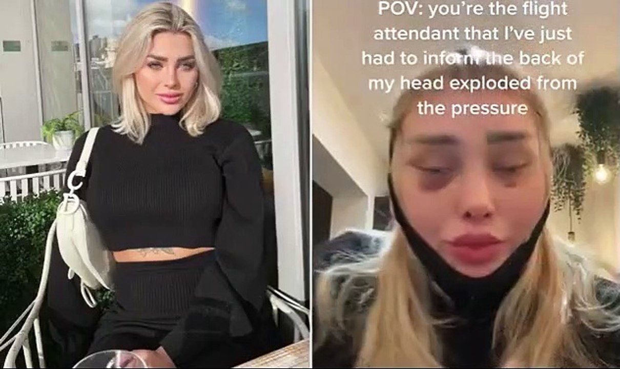 OnlyFans model goes viral after revealing how her 'head exploded' mid-flight - when stitches behind her ear popped open from air pressure following 'cat-eye' surgery in Turkey