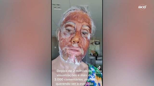 Troca de rosto: procedimento estético 'peeling' impressiona internautas