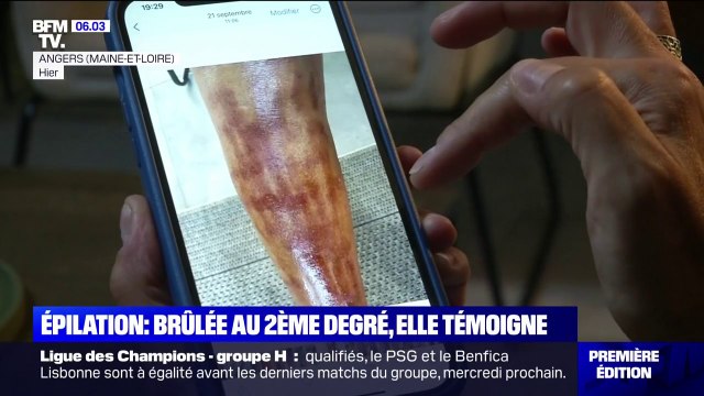 Il y avait des endroits où la peau partait : brûlée au 2ème degré à cause d'une épilation, elle témoigne