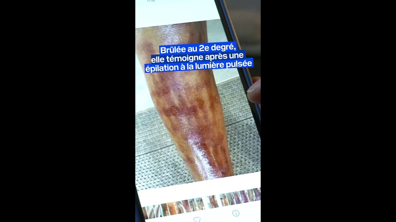 "La peau a commencé à cloquer": brûlée au 2e degré, elle témoigne après une épilation à la lumière pulsée