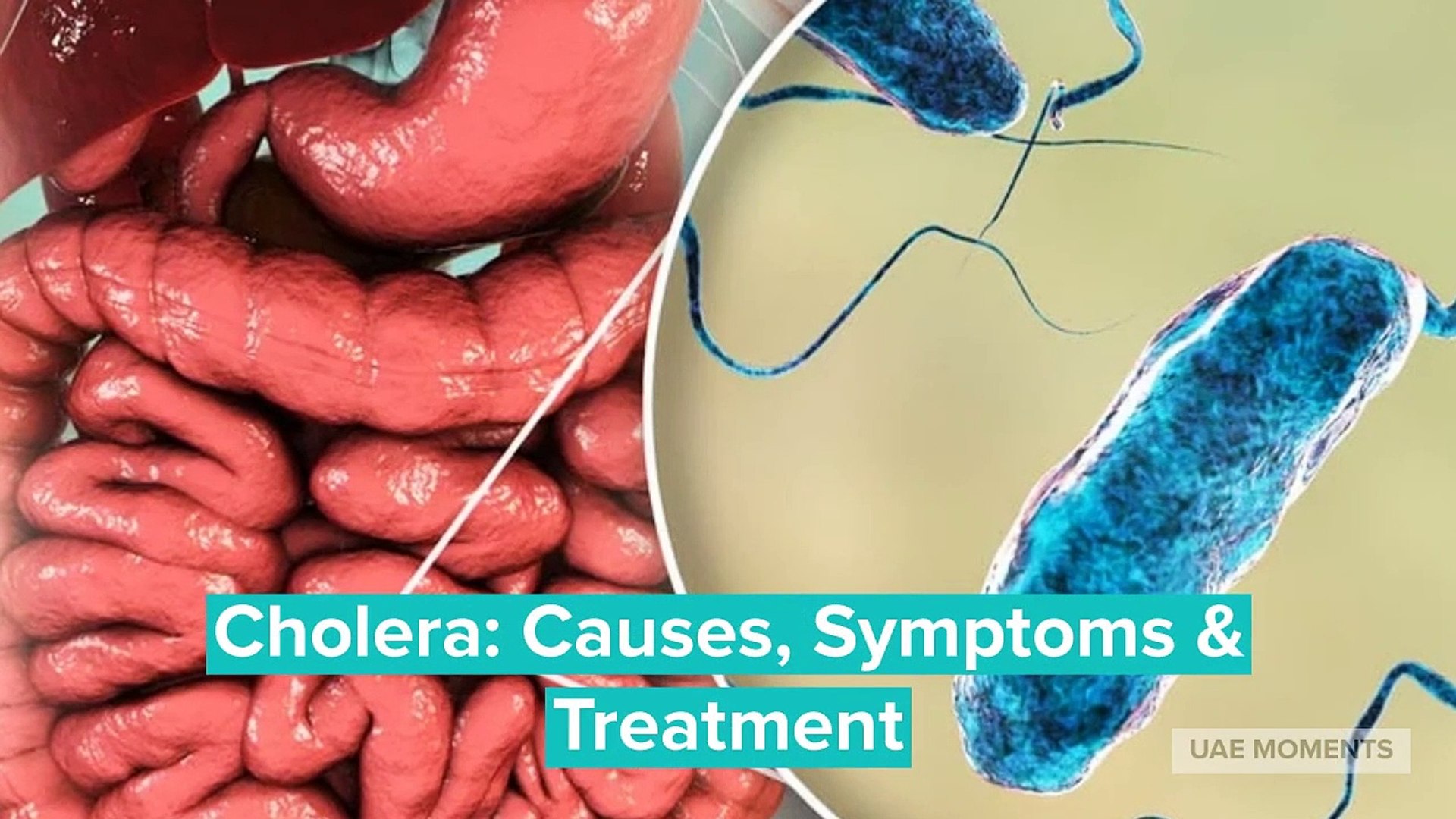 Cholera Symptoms And Causes