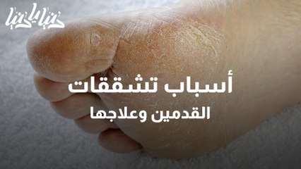 أسباب تشققات القدمين وعلاجها