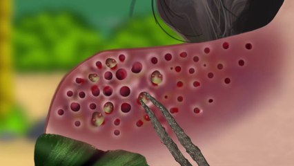 ASMR Remove Big Acne, Maggot Infection & Dry Mouth, Lip Care Animation