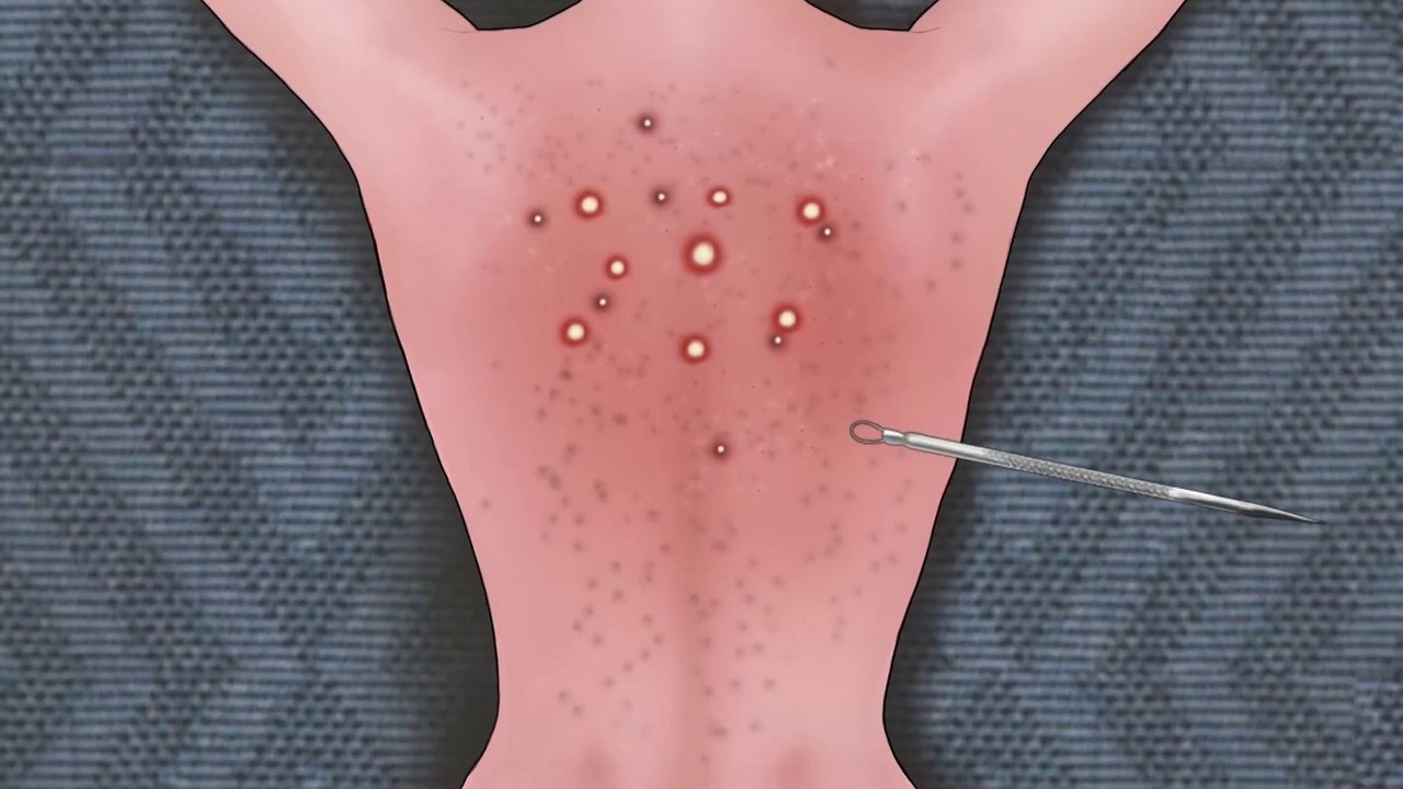 ASMR Remove Big Acne, Maggot Infection & Dry Mouth, Lip Care Animation
