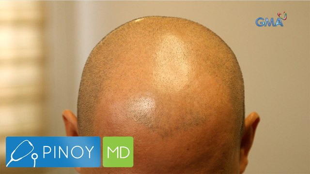 Hair tattoo o scalp micropigmentation, solusyon nga ba sa pagkakalbo? | Pinoy MD