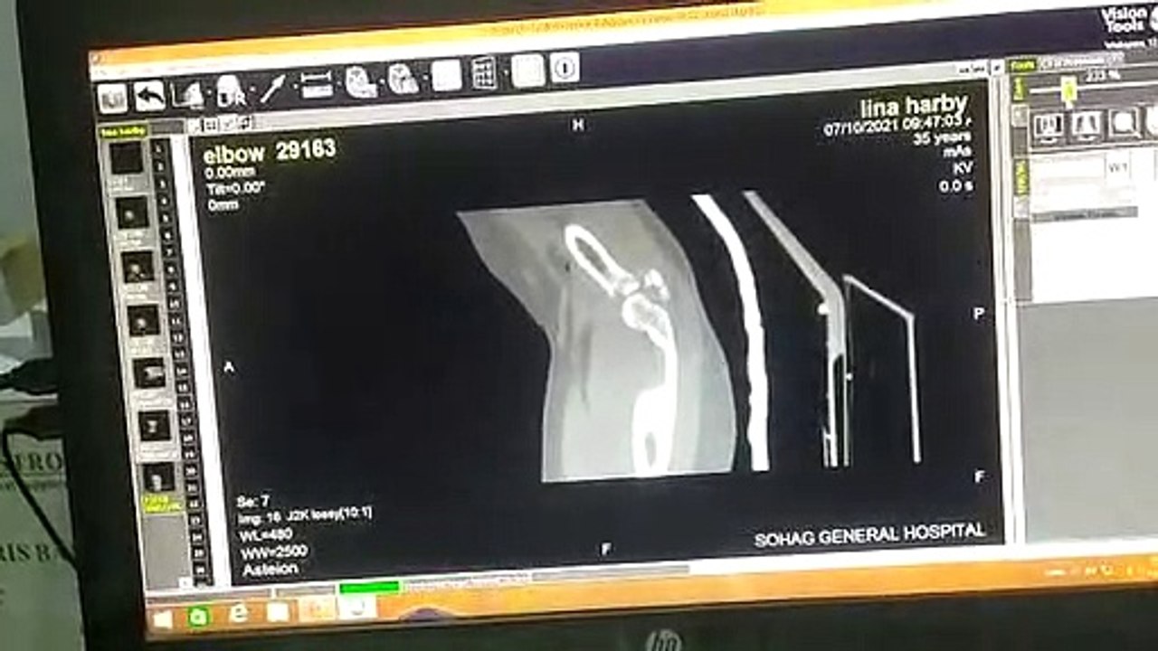 CT knee