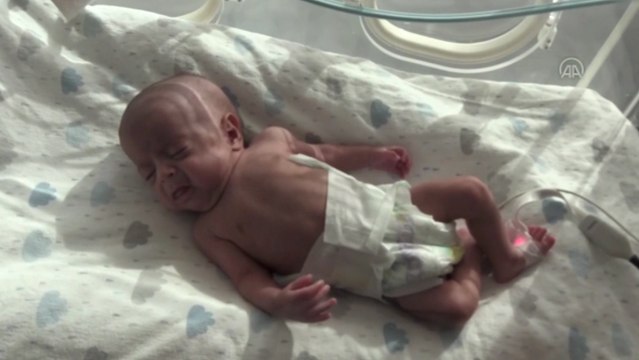 600 gramlık parmak bebek yaşama tutundu