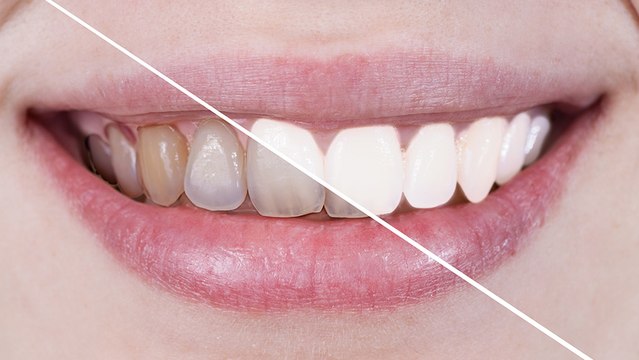 bd-causas-de-los-dientes-amarillos-011122