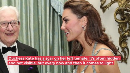 The Reason Behind The Scar On Duchess Kate's Face