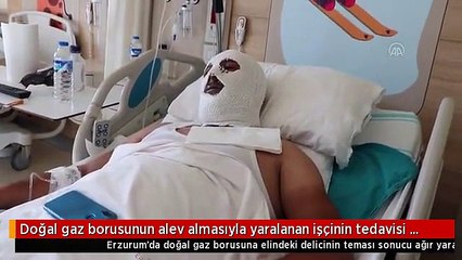 Doğal gaz borusunun alev almasıyla yaralanan işçinin tedavisi sürüyor