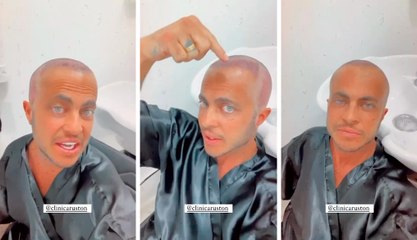 ‘Achei que ia ficar feio careca’, diz Thammy Miranda sobre transplante capilar