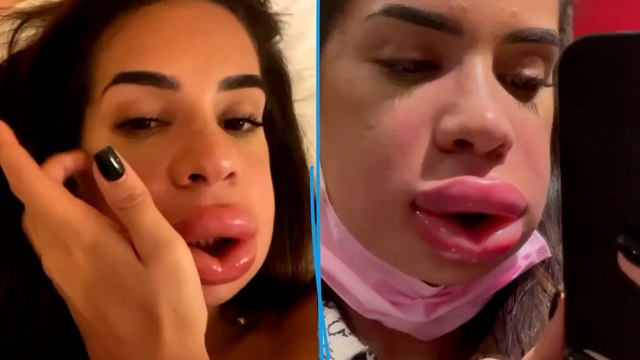«Elle aurait pu ne plus pouvoir respirer»: une influenceuse défigurée après des injections