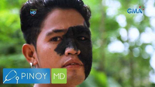 Pagkakaroon ng balat sa katawan, ano nga ba ang dahilan? | Pinoy MD