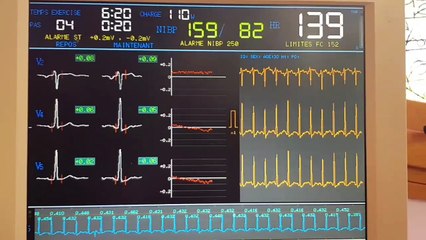 714 COMMENT SOIGNER NATURELLEMENT EXTRASYSTOLES A L EFFORT SUR COEUR NORMAL
