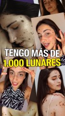 Tengo más de 1.000 lunares