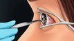 PUYA ASMR | 티눈 제거하는 방법 | 귀지 제거|귀 청소