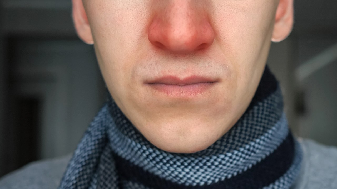 Wunde Nase: Diese Hausmittel helfen sofort!